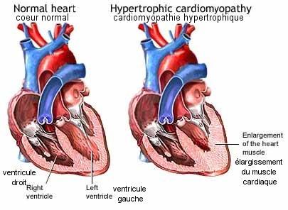 Pathologies Cardiaques Cardiomyopathie Hypertrophique Hcm